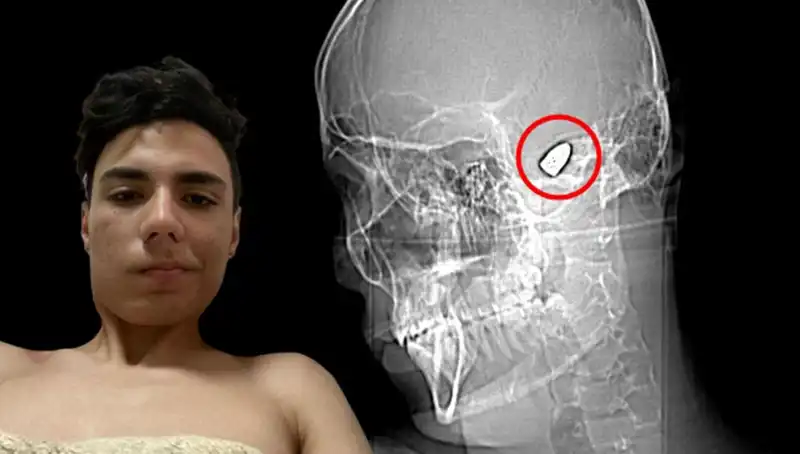 Kafasında Patlayıcı Bomba Taşıyan Adamın Hikayesi Dikkat Çekiyor